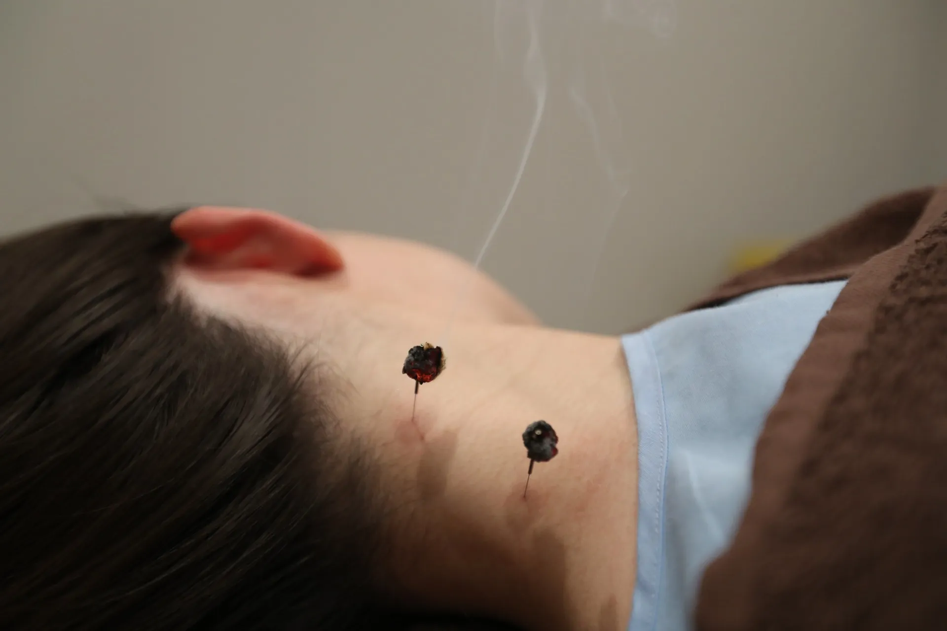 灸頭鍼 (もぐさ)